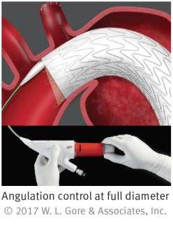 Device Design Impacts Clinical Outcomes The Angulation Control mechanism is designed to enhance the innate conformability of the GORE TAG Conformable Stent Graft.