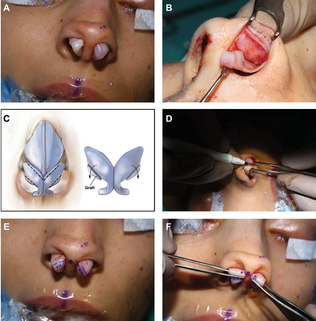 946 Aesthetic Surgery Journal 34(6) Figure 6. (A) The dome delivery technique is utilized to access the nasal tip of this 24-year-old woman.