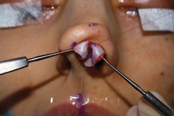 (B) A hanging columella deformity can be handled while maintaining the correct infralobule-to-nostril ratio via the anterior overlap procedure.