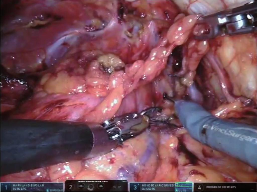 Removal of periprostatic fat tissue Bladder is retracted posteriorly with 4th-robotic arm holding the Prograsp forceps and this manoeuvre shows the intersection point of bladder neck and the prostate
