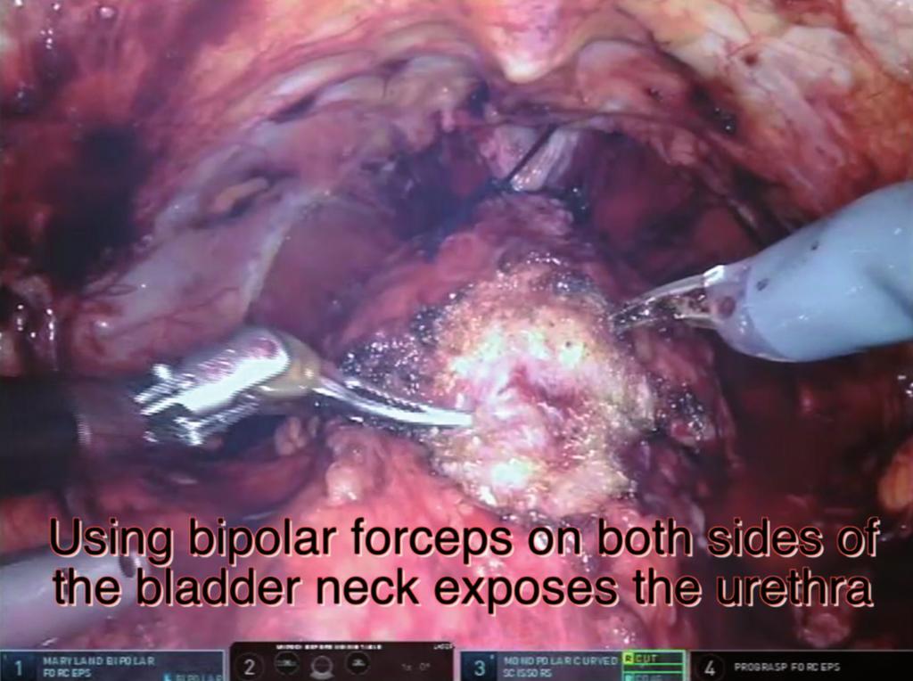 When the bladder neck is exposed, monopolar scissors is used on both sides of the bladder neck in order to enter the plane between the bladder and the prostate (Figure 7).