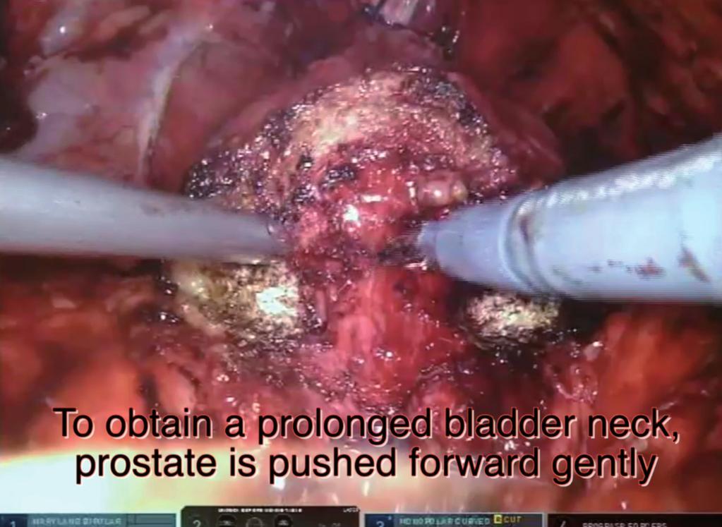 How to Preserve Bladder Neck During Robotic Radical Prostatectomy? Figure 9: Obtaining a prolonged bladder neck. Figure 10: Cutting the bladder neck. TAKE HOME MESSAGES 1.