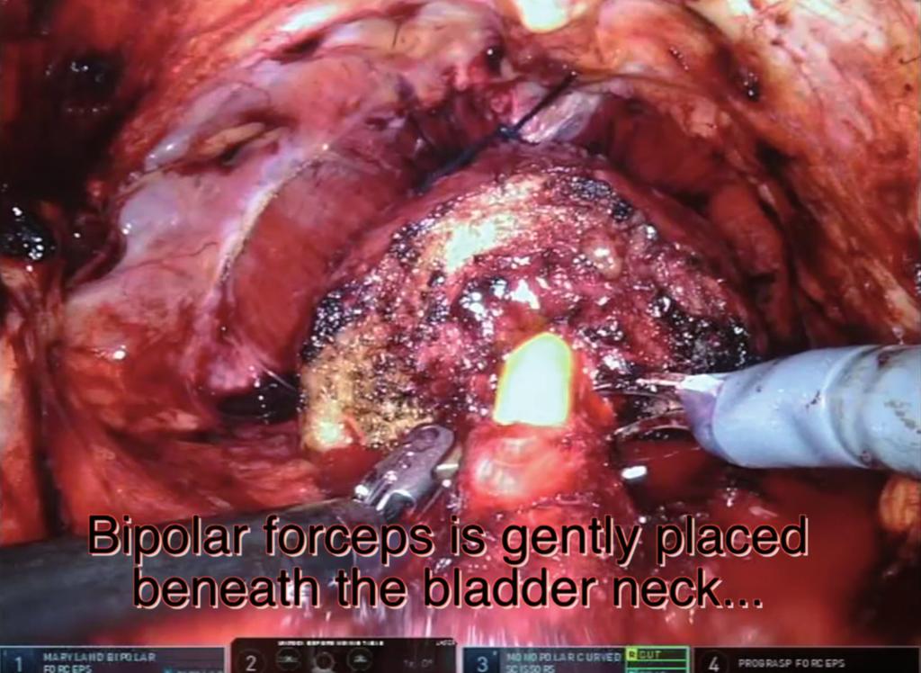 It is important not to use the cautery too much and not to enter a deeper plane that could lead to damaging the bladder neck and disruption of the surrounding tissues that could damage the normal