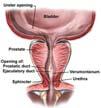 Indications for Prostatectomy Good performance status and 10y life expectancy Localized disease Ideally low and