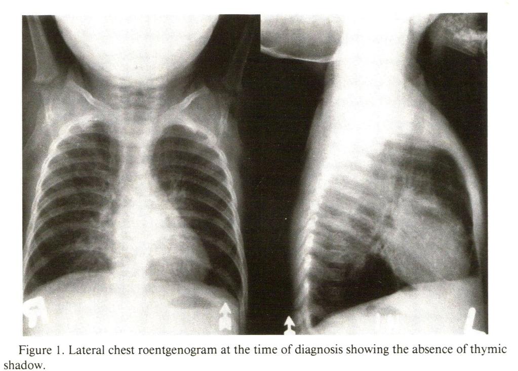 Work-up includes: Chest x-ray, CBC with differentiation, IgG, IgA, IgM.