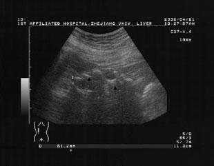 ultrasound shadow. The renal pelvis and calyces were separate and within that area there was an anechoic dark zone. The ureter could be distended (Fig. 6). Discussion 1.