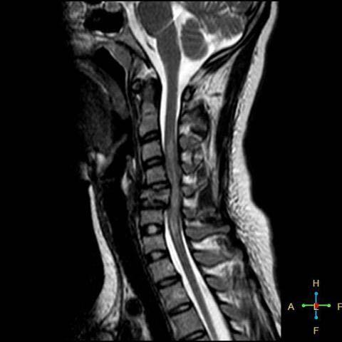 5 Cervical Spine Injuries Fracture Patterns Flexion: most common mechanism Anterior atlantoaxial subluxation Anterior subluxation (hyperflexion sprain)