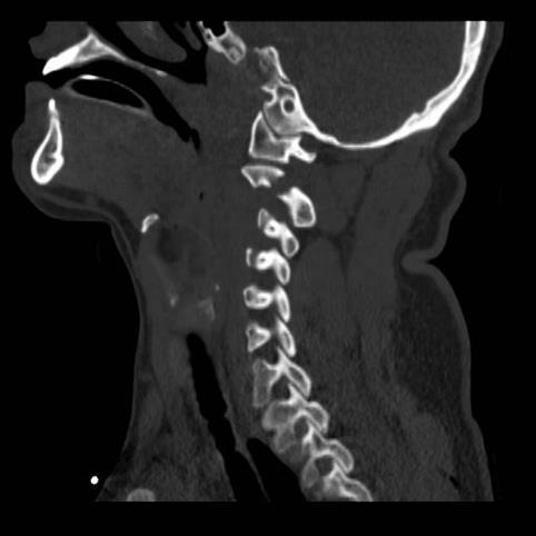Unilateral occipital condyle fracture Lateral mass C1 fracture Flexion-rotation Unilateral facet dislocation Rotatory atlantoaxial dislocation Extension