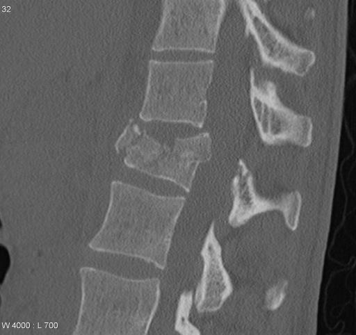 7 Extension-rotation Articular pillar fracture 5 Floating pillar Axial loading/compression Burst fracture (with axial loading) Jefferson fracture Complex injuries Atlantooccipital dissociation