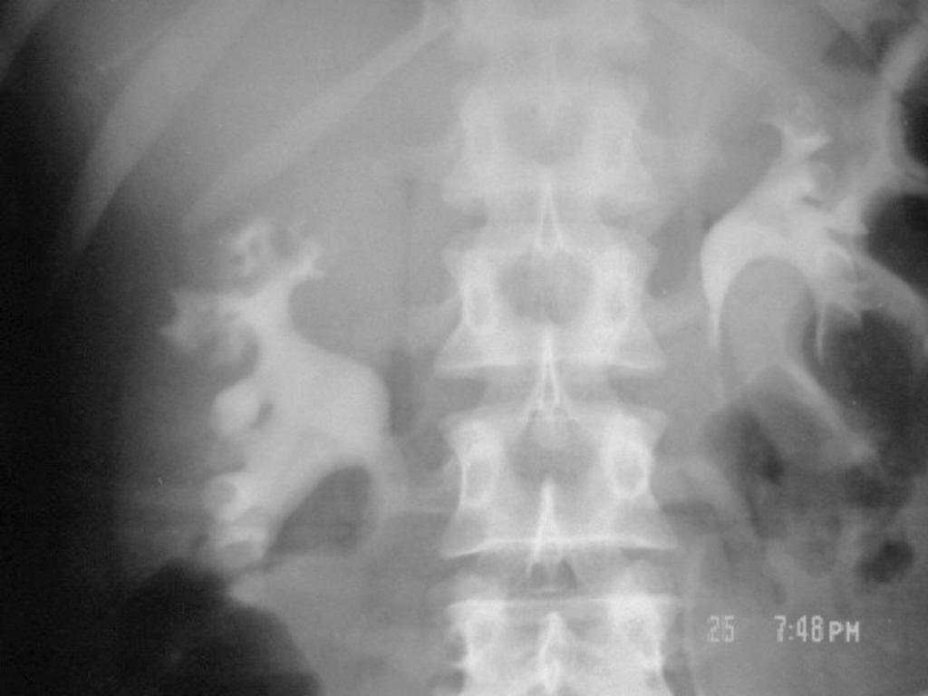 Fig. 9: Spot film from retrograde pyelography shows moth-eaten pelvicalyceal system communicating with parenchymal abscess cavity. Fig.