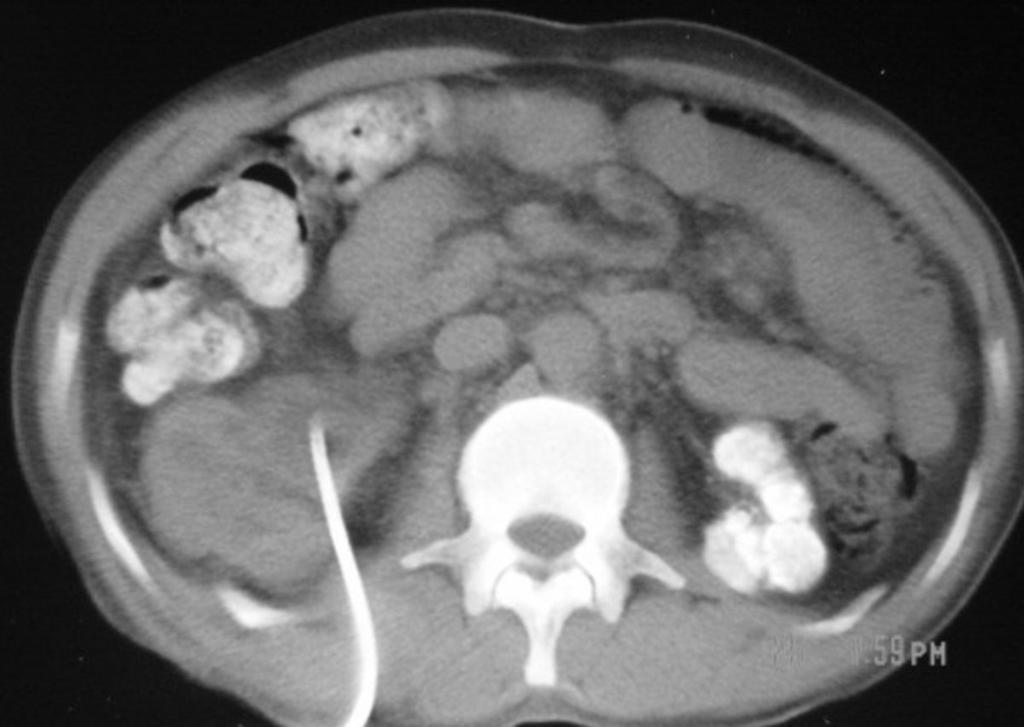 Fig. 12: Axial CT scans in 2 different patients showing (a) Scarred hydronephrotic right kidney with perinephric fat stranding and