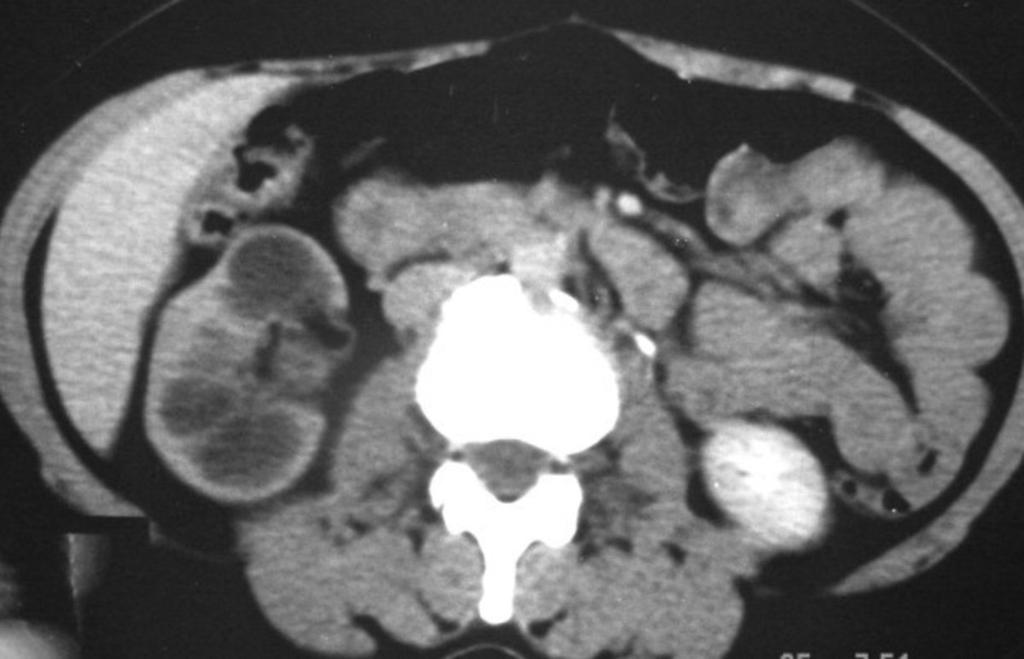 Fig. 13: Axial CT scans in 2 different patients showing (a) Scarred hydronephrotic right kidney with perinephric fat stranding and