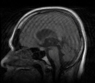 Figure 3 Figure 3. MRI, sagittal T1-weighted image. There is a ballooning dilatation of the cerebral aqueduct, and enlargement of the third ventricle.