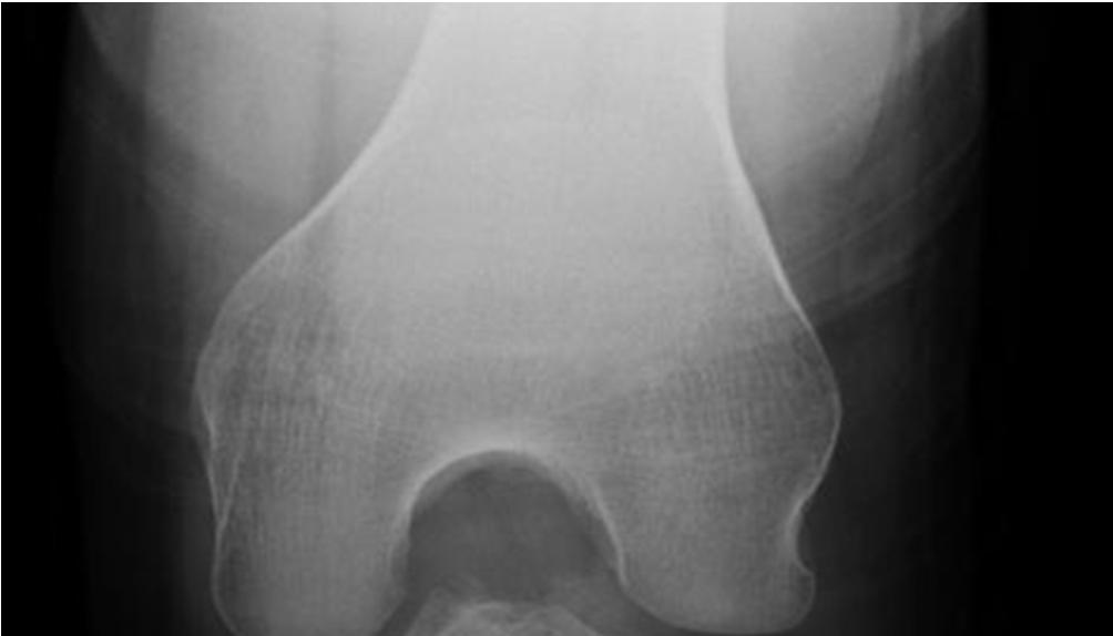 Knee Pain- Case 1