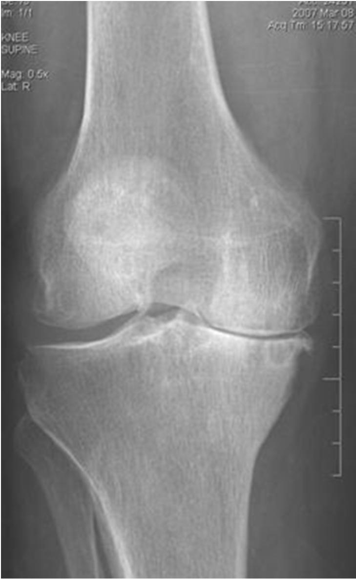 Knee Pain- Case 3 Radiographs Joint space