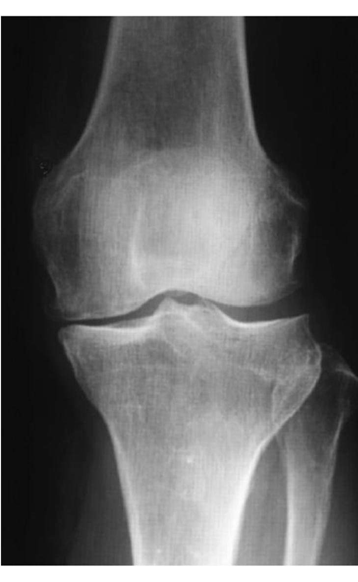 Knee Pain-