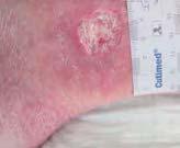 periwound skin (White et al, 2015). Excessive exudate slows or prevents cell proliferation, and interferes with the availability of growth factors (Romanelli et al, 2010).