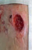 during application and removal Gentle adherence to periwound areas without trauma a Pain at dressing change.