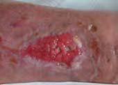 Nurse Res 11(4): 42 53 Chen WY, Rogers AA, Lydon MJ (1992) Characterization of biologic properties of wound fluid collected during early stages of wound healing.