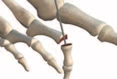 Pre-Drilling: Proximal Phalanx After resection and debridement of the PIP joint, select the 1.