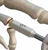phalanx, minimizing the potential for postoperative distraction of the PIP joint.