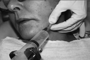 Slika 6.2: Uzimanje uzorka tkiva metodom FNA vođenu ultrazvukom Izvor: Slika autora Ana Paula Candido dos Santos (www.scielo.br).