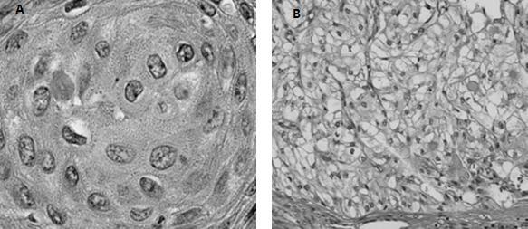 3.Epidermoidne ćelije Na mikrografiji (Slika 2.4A) uočljive su epidermoidne ćelije poligonalnog ili vretenastog oblika sa eozinofilnom citoplazmom. Keratinske perle se veoma retko viđaju.