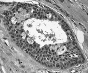 Psamomatozni Seborični Sklerozirajući tip MEK-a karakteriše se sklerozom centralnog dela sa hroničnim limfocitnim infiltratom na periferiji tumora (Slika 2.