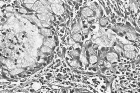 13: MEK-a peharastih ćelija (H&E x 200) Izvor: Mikrografija autora Luna M.A. [5] Znatno ređi su spamomatozni i MEK sa vretenastim ćelijama.