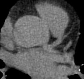 Score Unknown Lp(a),?HDL Dysfunction Number of (RF) Nasir K, Circ Cardiovasc Imaging.