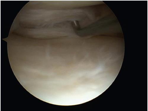 Horizontal Cleavage Tears Resecting one leaflet Makes it look prettier Decreased