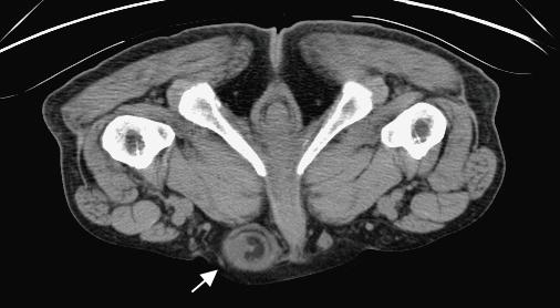 Hui-Yu Lin Chun-Hou Liao Yu-Wei Chou showed a hepatic hemangioma and right inguinal hernia with a small segment of small bowel in the herniation sac (Fig. 1).