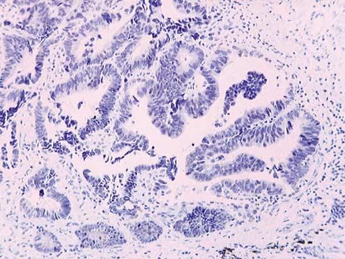 In some areas, the intensity of nuclear staining in tumor cells was similar to that in adjacent normal pneumocytes.
