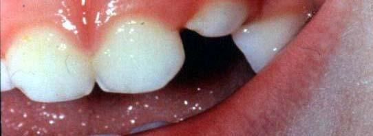 intruded tooth Analgesics, warm saline rinses, consider antibiotics Dental
