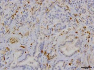 gross liver metastasis (n=) an primary PDAC tumors (n=6) staine for by IHC.