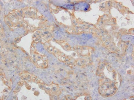 gross liver metastasis (f) an primary PDAC tumors (g) staine for by IHC.