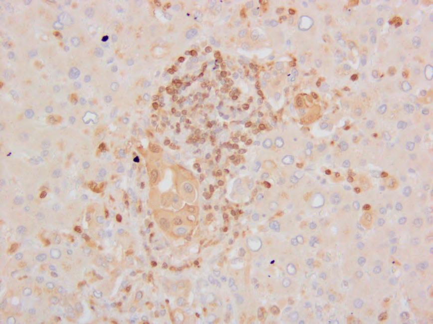 primary tumors (n=6) or within one cell iameter for micro-metastases (n=57).