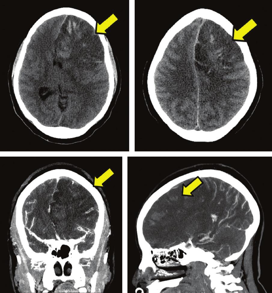 Cerebral Venous Thrombosis KEY POINT h Seizures are a common manifestation, observed in 30% to 50% of patients with cerebral venous thrombosis.
