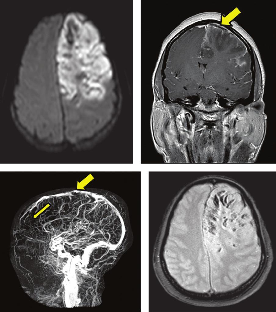 The magnetic resonance venogram (C) shows few multifocal filling defects involving the superior sagittal sinus. These defects are nonobstructive.