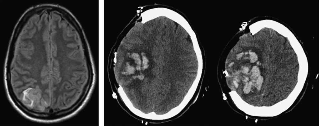 Cerebral Venous Thrombosis Case 5-5 A 32-year-old woman presented to the emergency department after having a generalized tonic-clonic seizure witnessed by her husband.