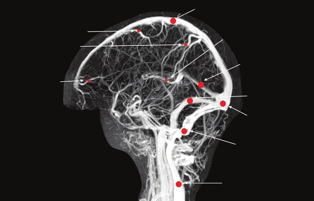 FIGURE 5-1 Cerebral venous thrombosis: most commonly affected sinuses. The sagittal sinus is the most commonly affected, followed by the transverse sinuses. Modified from Saposnik G, et al, Stroke.