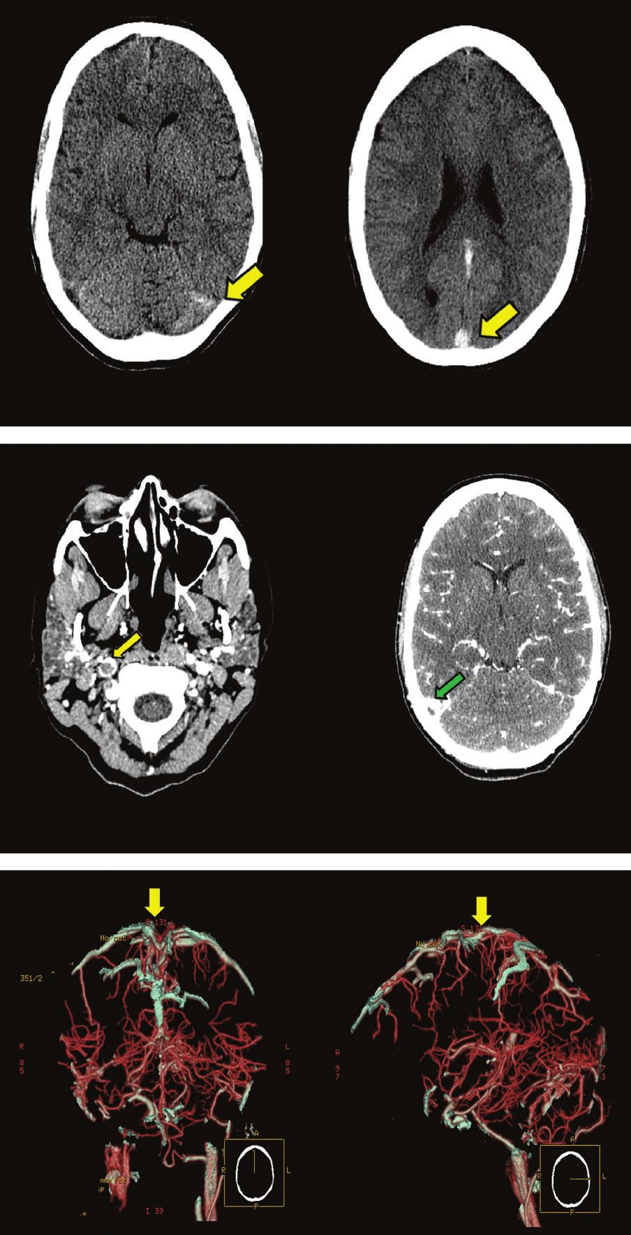 Cerebral Venous Thrombosis (AHA) and the European Federation of Neurological Societies (EFNS) guidelines recommend MRI/MRV as the preferred brain image, whereas CT/CT venogram is an acceptable option