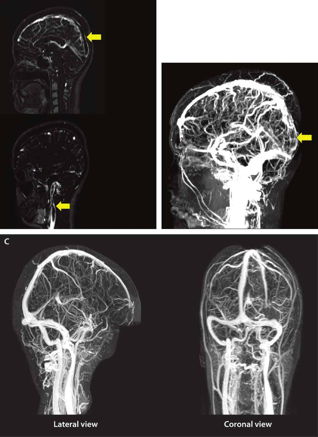 Cerebral Venous Thrombosis Continued from page 339 FIGURE 5-3 A young woman with headache.