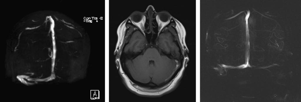 Case 5-2 A 27-year-old woman, 19 weeks pregnant with a history of migraine headaches, developed severe occipital headache that increased in severity over the course of 5 days, unlike her usual