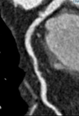 Evaluating chest pain by Coronary Computed Tomography angiography