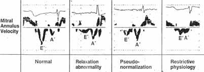the difference between normal mitral flow and diastolic dysfunction in form of pseudo-normalization.