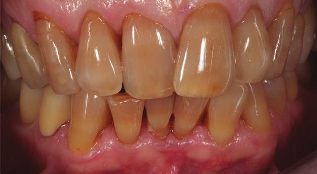 tetracycline staining) (Figs. 1 and 2). Orthodontic treatment was suggested.