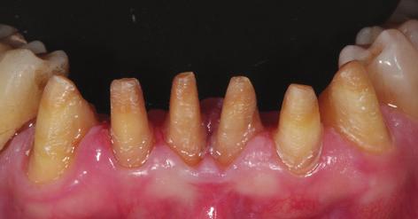 Based on the digital wax-up, provisionals were milled in the practice prior to the second appointment from PMMA blocks (Telio CAD, Ivoclar Vivadent), which eliminated the challenges associated with