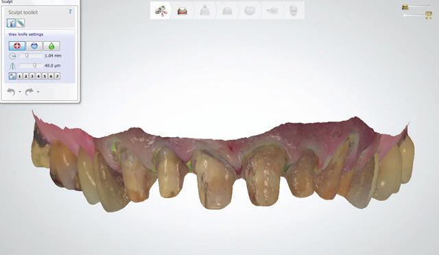 These CAD/CAM created provisionals also contributed to an ideal fit, strength, and durability. During the second appointment, the teeth were prepared (Figs. 8 and 9) and digital scans taken (Figs.