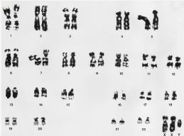 Sterile o Normal intelligence Turners Syndrome (XO) - 1:3000 female births - Absence of a sex chromosome o